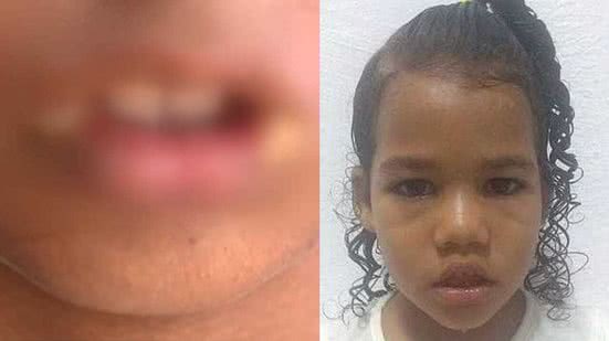 Maria Clara desapareceu em 2021 e é irmã da criança ferida com um ovo quente na boca - Montagem TNH1