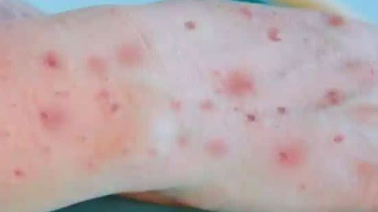 A maioria das infecções se concentra na faixa etária dos 30 aos 39 anos (751 casos). - Divulgação