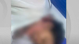 Mulher está internada no HGE para tratamento das queimaduras - Foto: Reprodução / TV Pajuçara