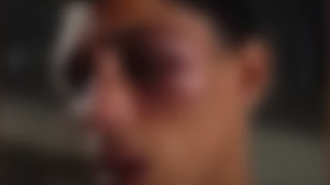 Rosto do jovem de 19 anos ficou inchado, seu olho esquerdo ficou roxo e há ainda marcas de agressão na boca, além de pequeno corte na região da testa. - Foto: Reprodução