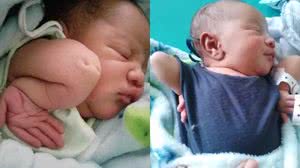 Imagem Bebê nasce com ombros virados para baixo e cotovelos virados para cima; entenda a condição