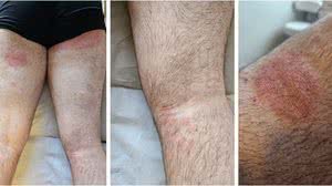 Foto: Reprodução/Veasey et al.