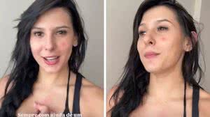 A cantora Ana Castela, de 21 anos, compartilhou em suas redes sociais sua luta de anos contra a acne - Reprodução / Instagram