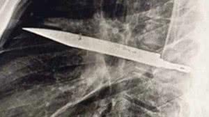 Foto: Reprodução/Journal of Surgical Case Reports