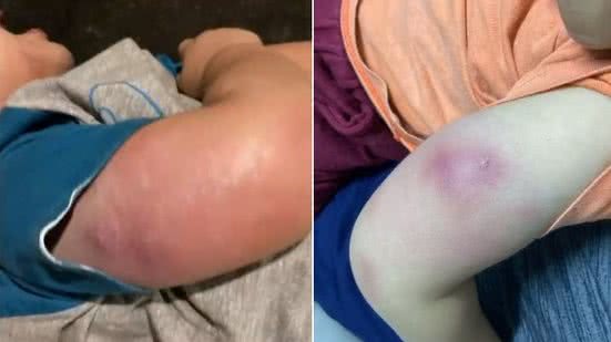 Mãe denuncia após filho ter infecção com aplicação de vacina em posto de saúde - Reprodução / TV Pajuçara