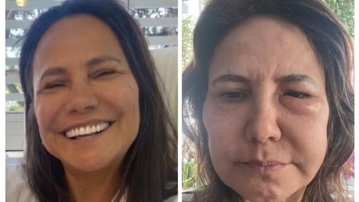 Mulher tem reação alérgica ao ácido hialuronico mais de um ano após ...