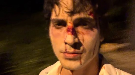 Fiuk aparece com rosto ensanguentado e assusta fãs: 'Precisa de tratamento' - Reprodução / Instagram