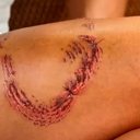 Turista mostra perna com marcas de mordida de tubarão em Noronha - Ana Clara Marinho / TV Globo