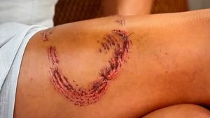 Turista mostra perna com marcas de mordida de tubarão em Noronha - Ana Clara Marinho / TV Globo