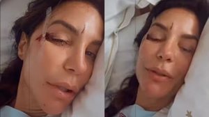 Ivete Sangalo surge em hospital com machucados no rosto e relata susto - Reprodução / Instagram