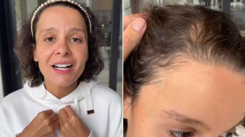 Maiara, da dupla com Maraisa, desabafa sobre alopéciaReprodução / Instagram