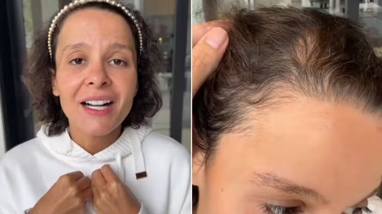 Maiara, da dupla com Maraisa, desabafa sobre alopécia - Reprodução / Instagram