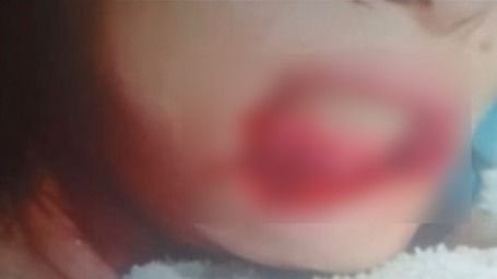 Mulher tem lábio arrancado por ex-companheiro em Viçosa - Reprodução