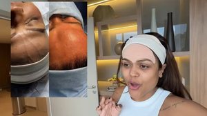 Camila Loures retira veia na testa - Reprodução / Redes sociais