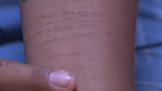 Marcas da violência no corpo da vítima, que não será identificada na reportagem - Reprodução / TV Pajuçara