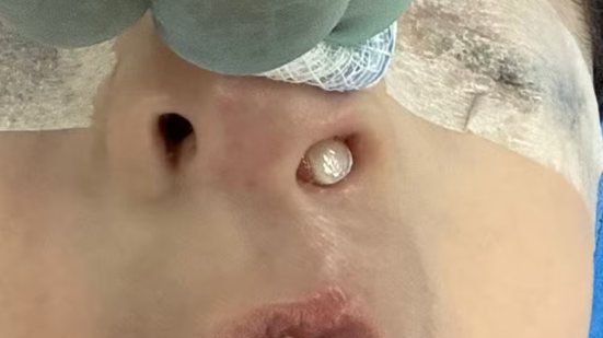 Dente nasce dentro do nariz de criança, no Paraná\u003B veja fotos