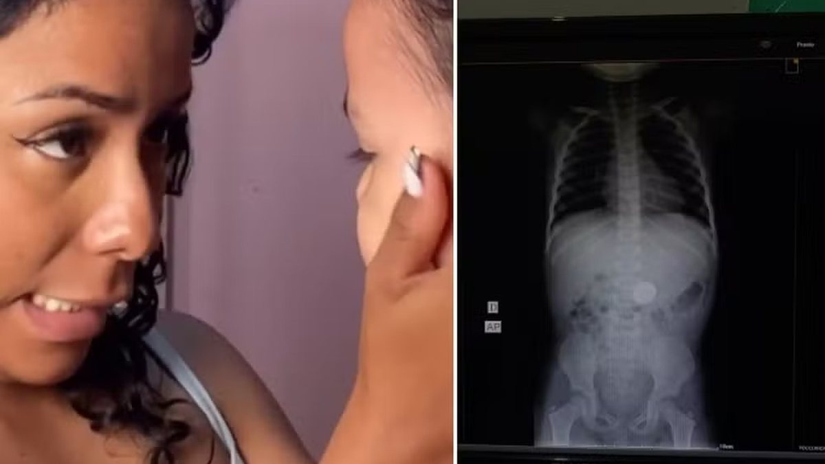Mãe fica sem reação após filha revelar o que engoliu e raio X confirma