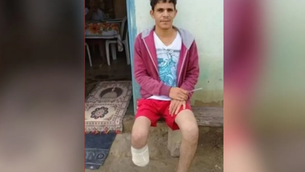 Homem é condenado por amputar o pé para receber seguro milionário na Bahia