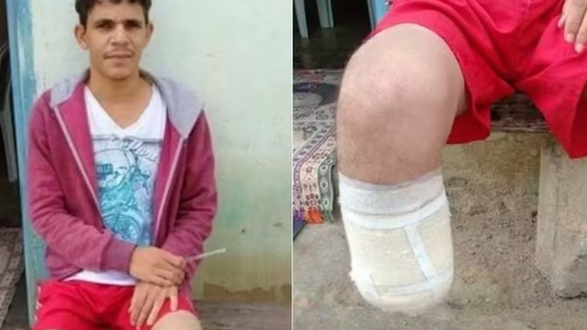 Servidor baiano que amputou o próprio pé para tentar receber R$ 1,5 milhão teve membro achado em mochila