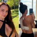 Imagem Influencer 'vidente' não prevê acidente com carregador e acaba com as costas queimadas