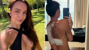 Imagem Influencer 'vidente' não prevê acidente com carregador e acaba com as costas queimadas