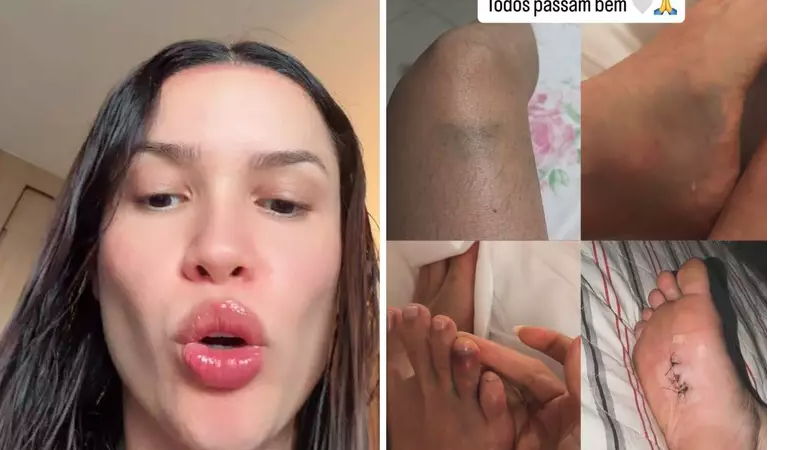 Juliette mostra hematomas após despedida de solteira e brinca: 'Confundiram com o fim do mundo'