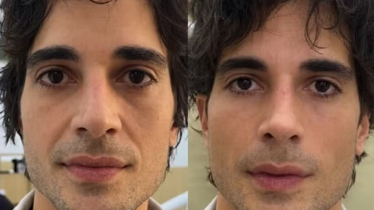 Fiuk surpreende com novo visual após harmonização facial\u003B veja antes e depois