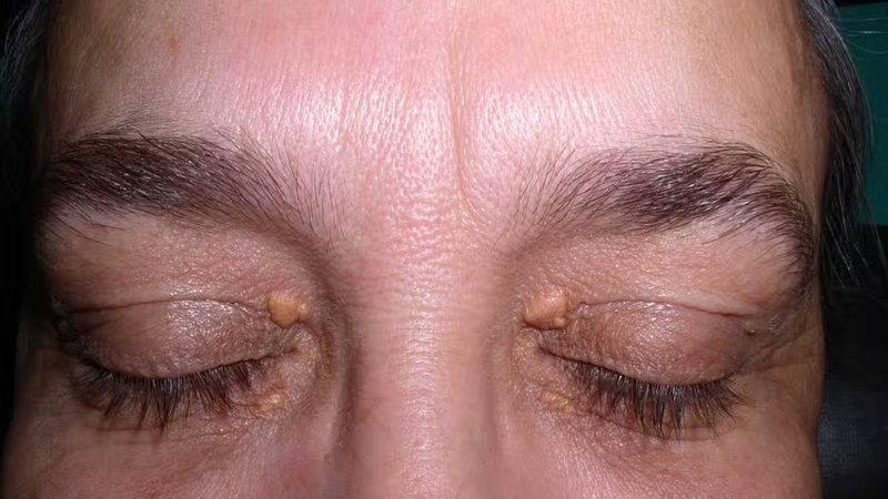 Estudo indica que sinais amarelados nos olhos podem indicar risco de AVC e infarto