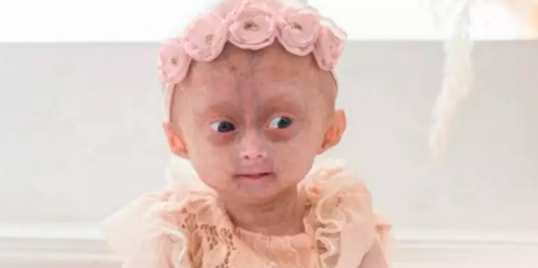 Quem era a gêmea brasileira com 'Síndrome de Benjamin Button' que morreu em Roraima