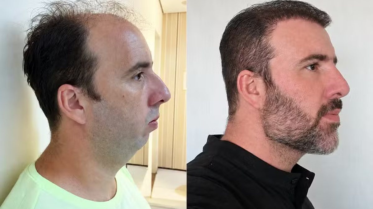 Homem viraliza após harmonização facial\u003B antes e depois surpreende