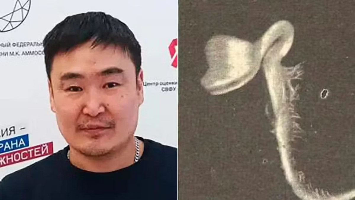 Homem sente dores de cabeça, vai ao médico e descobre planta em olho