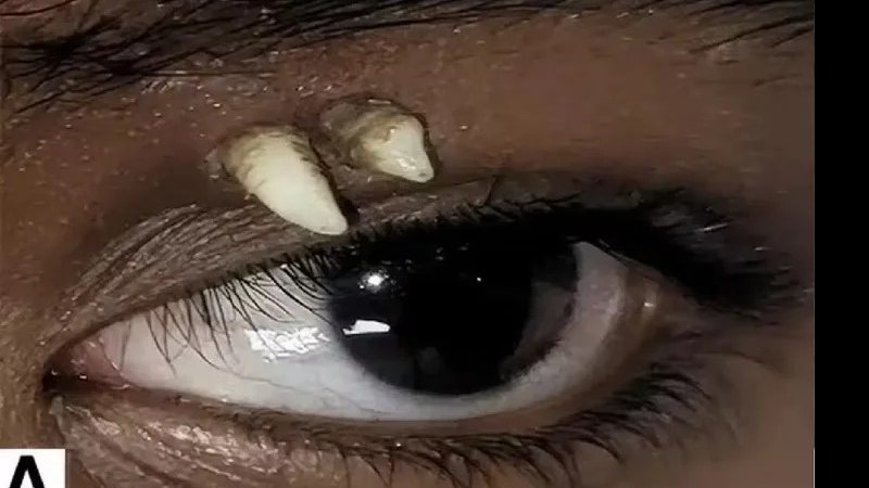 Adolescente procura médico por inchaço e descobre dentes crescendo perto do olho