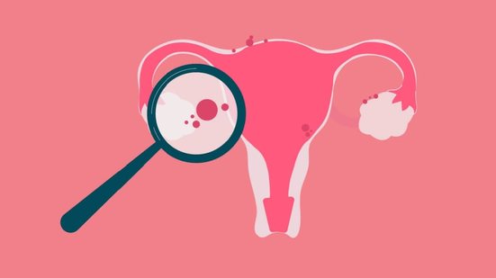 Com sintomas confundidos com outras condições, a endometriose exige acompanhamento especializado (Imagem: Gegambar | Shutterstock)