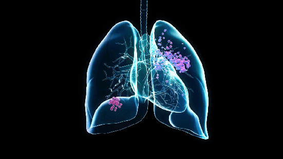 Ampliar a prevenção e a identificação precoce do câncer de pulmão é fundamental para reduzir a taxa de mortalidade (Imagem: Julien Tromeur | Shutterstock)