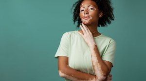 O vitiligo é caracterizado por áreas despigmentadas na pele (Imagem: Dean Drobot | Shutterstock)