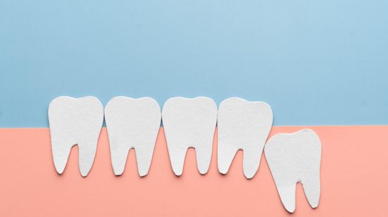 Nem sempre há espaço suficiente na boca para que os dentes do siso nasçam corretamente (Imagem: Orawan Pattarawimonchai | Shutterstock)