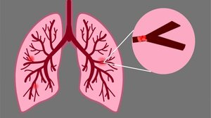 A embolia pulmonar pode atingir qualquer idade, mas a incidência aumenta com o envelhecimento e em situações específicas (Imagem: Sivakumar sasidharan | Shutterstock)