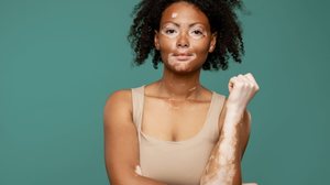 O vitiligo é uma doença autoimune que provoca a descoloração da pele (Imagem: Dean Drobot | Shutterstock)