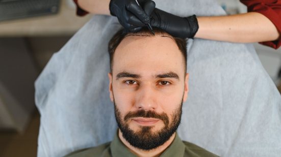 A recomendação de um novo transplante capilar varia conforme as especificidades do paciente (Imagem: Hryshchyshen Serhii | Shutterstock)