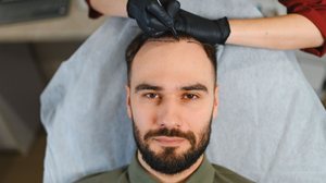 A recomendação de um novo transplante capilar varia conforme as especificidades do paciente (Imagem: Hryshchyshen Serhii | Shutterstock)