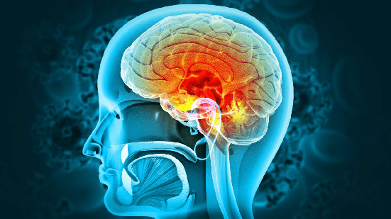 A meningite é a inflamação das meninges, causada por vírus, bactérias, fungos ou parasitas, que afeta cérebro e medula espinhal (Imagem: crystal light | Shutterstock)