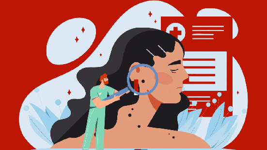 Exposição solar acumulada, histórico familiar e características individuais podem aumentar as chances de desenvolver a doença (Imagem: mentalmind | Shutterstock)