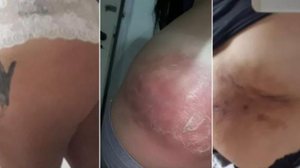 Mulher ficou com bumbum deformado após receber injeção em pronto-socorro de Santos, SP | Foto: Arquivo Pessoal