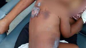 Imagem Criança que teve corpo queimado vai passar por exame após sinais de abuso sexual
