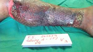 Pele de tilapia usada em tratamento de queimaduras | Reprodução