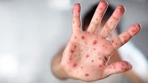 Imagem OMS alerta para recorde de casos de sarampo na Europa