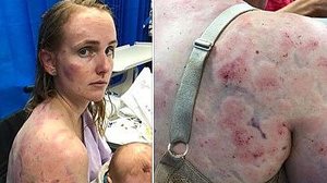 Fiona ficou cheia de hematomas | Reprodução / Facebook