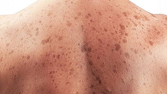 O câncer de pele está entre os mais frequentes na população. Quando diagnosticado de maneira rápida, as chances de cura são altas | Foto: Reprodução/Pixabay