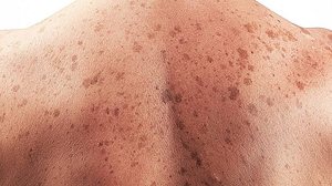 O câncer de pele está entre os mais frequentes na população. Quando diagnosticado de maneira rápida, as chances de cura são altas | Foto: Reprodução/Pixabay