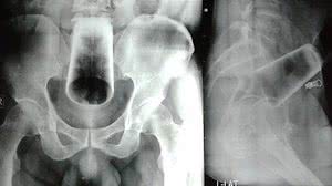 Reprodução/Journal of the Nepal Medical Association Reprodução/Journal of the Nepal Medical Association